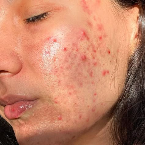 Skin Texture Photography, Human Imperfection, Acne Photography, Strawberry Freckles, Acne Positive, Acne Photos, Acne Is Normal, Real Skin Texture, Acne Aesthetic