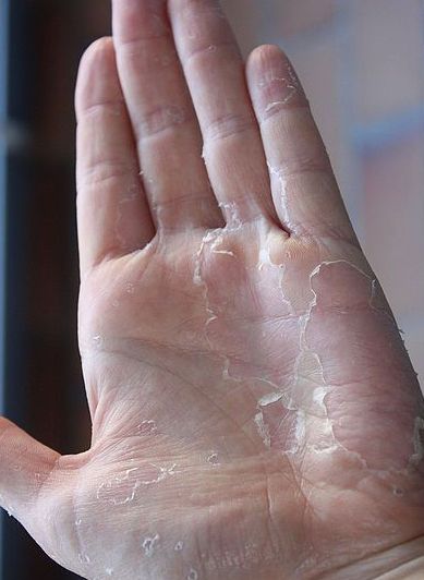 10 Things Your Hands Can Tell About Your Health—Do Your Hands Ever Feel Like Pins and Needles? Skin Rashes Pictures, Tingling Hands, Numbness In Hands, Zinc Rich Foods, Too Much Coffee, Nail Polish Trends, Nerve Damage, Peeling Skin, Pins And Needles