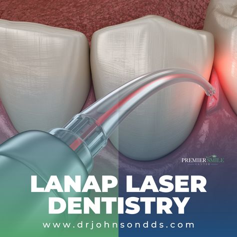 LANAP laser dentistry is designed to target the diseased areas of the gum to reduce inflammation and clear away the infected areas. A local anesthetic is applied to the gums and the super-fine, high-powered dental laser is inserted between the infected tooth and gum. A sophisticated tool, the dental laser recognizes and avoids healthy tissue, focusing only on the areas that need healing. ⭐BOOK NOW⭐ 📱(954) 566-7479 #PremierSmileCenter #LANAP #LaserDentistry #FortLauderdaleDentist Dental Laser, Laser Dentistry, Reduce Inflammation, Gum, Target, Healing, How To Apply