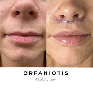 Lip Lift Before and After Gallery Lip Lift Before And After, Lip Flip Before And After, Lip Flip Fibroblast, Lip Plastic Surgery, Lip Lift Surgery, Lip Flip, Facelift Before And After, Lip Lift, Botox Before And After