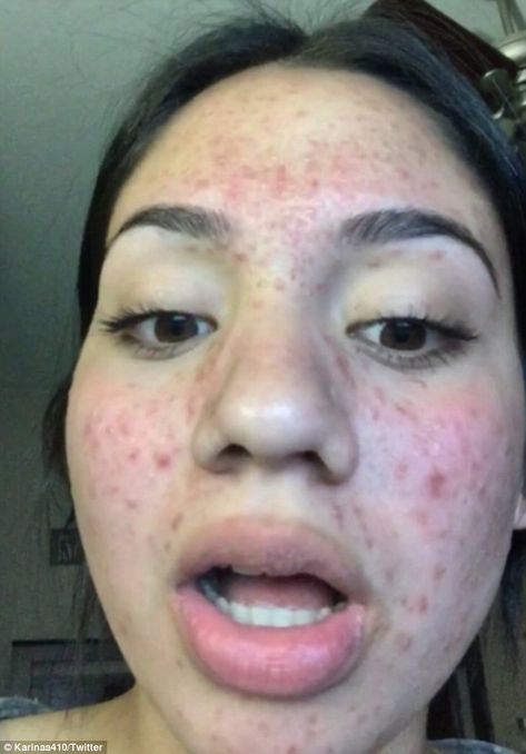 Girl With Acne, Clear Skin Detox, Cystic Acne Remedies, Overnight Beauty Hacks, Blind Pimple, Drugstore Products, Bad Acne, Acne Overnight, Natural Acne Remedies