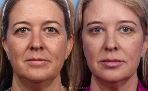 Upper Eyelid Surgery and Liquid Face Lift beautiful results Eye Hollows, What Is Fiction, Facelift Before And After, Liquid Facelift, Cosmetic Fillers, Eyebrow Lift, Natural Face Lift, Facial Fillers, Injectables Fillers