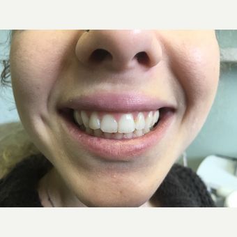 Invisalign Before & After Pictures - RealSelf Invisalign Before And After, Before And After Invisalign, Medical Consultation, Before After Photo, After Pictures, Before And After Pictures, Healthcare Professionals, Health Care