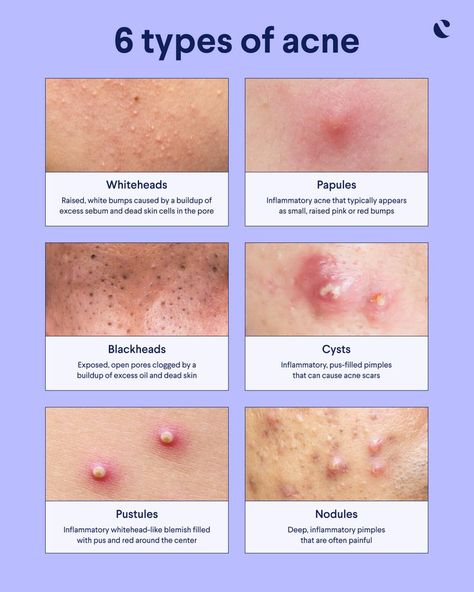 Acne Types, Different Types Of Acne, Moderate Acne, Mild Acne, Bad Acne, Skin Advice, Basic Skin Care, Severe Acne, Types Of Acne