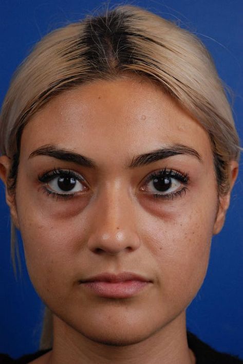 Patient 12973892 | Tear Troughs Before & After Photos | Marcus Medical Trough Filler Before After, Under Eye Surgery Before And After, Plump Under Eyes, Undereye Fillers Before And After, Tear Through Eye Filler, Under Eye Botox Before And After, Eye Surgery Before And After, Tear Through Filler Before And After, Tear Trough Remedy Natural