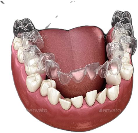 Invisalign Braces or Invisible Retainer Make Bite Correction Orthodontist Aesthetic, Before And After Invisalign, Invisalign Attachments, Invisalign Hacks, Invisalign Tips, Orthodontics Marketing, Orthodontics Teeth, Invisalign Aligners, Invisalign Braces