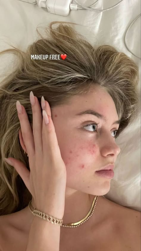 Girl With Acne Aesthetic, Girl With Acne, Leni Klum, Makeup Free, Face Aesthetic, Bare Beauty, Bare Face, Facial Skin Care Routine, Love Your Skin