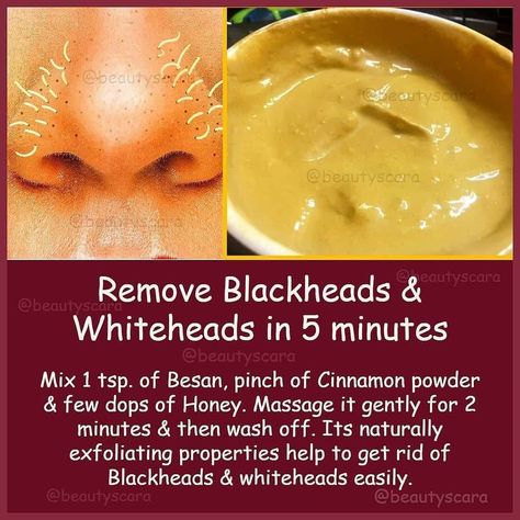 Blackheads And Whiteheads, Blackhead Remedies, To Remove Blackheads, Beauty Tips In Urdu, Black Heads, Remove Blackheads, Get Rid Of Blackheads, Homemade Beauty Tips, Skin Care Recipes