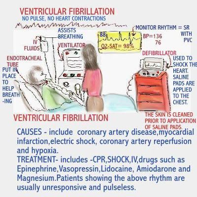 V Fib Cardiac Rhythms, Nursing Iv, Nursing Planner, Emt Study, Nursing Videos, Pharmacology Studying, Ekg Interpretation, Pa Life, Nclex Pn