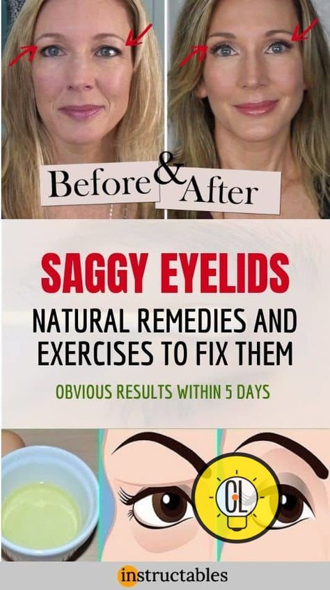 Droopy eyelid exercises to lift saggy eyes - ListPink Eyelid Exercises, Saggy Eyes, Saggy Eyelids, Sagging Eyelids, Droopy Eyelids, What Is Health, Eyelid Lift, Healthy Book, Eye Exercises