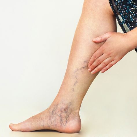 Home Remedies For Spiders, Varicose Veins Causes, Leg Veins, Vein Removal, Venous Insufficiency, Stretch Mark Removal, Muscle Aches, Blood Flow, Cider