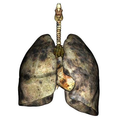 Lung Disease. 3D render of diseased lungs #Sponsored , #AFFILIATE, #SPONSORED, #Disease, #diseased, #render, #Lung Lungs Sculpture, Real Lungs, Lungs Illustration, Path Illustration, Pollution Activities, Lungs Anatomy, Lungs Art, Anatomy Science, Black Lungs