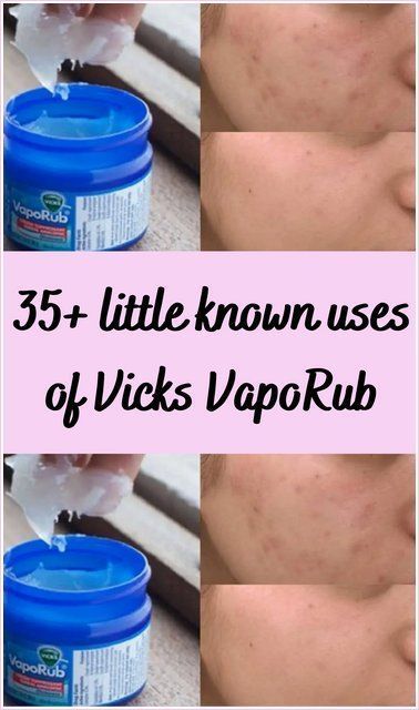 Shareably Pins, Homehacks Pins, Bug Repellant, Vicks Vapor Rub, Vicks Vapor, Vicks Vaporub Uses, Uses For Vicks, Vapor Rub, Treat Acne