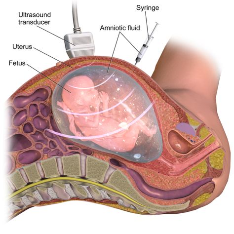 The key difference between amniocentesis and chorionic villus sampling is that in amniocentesis, a small amount of amniotic fluid is taken for testing while in chorionic villus sampling, a small sample of the placenta is taken for testing. Amniocentesis and Chorionic Villus Sampling are two prenatal diagnostic. Patau Syndrome, Fetal Heart Rate, Ultrasound Technician, Preterm Labor, Amniotic Fluid, Gestational Age, Prenatal Care, Genetic Disorders, Genetic Testing