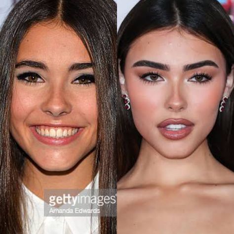 Madison Beer lip filler, face lift, eyebrow lift, canthoplasty (foxy eye surgery) eyebrow lift; Botox, lip flip, alarplasty (nose job) jaw/chin fillers and implants, cheek fillers Lip Lift Before And After, Bigger Top Lip Filler, Chin Fillers Before After, Lip Flip Botox Before And After, M Shape Lip Filler, Lip Flip, Pixie Tip Lift Nose Filler, 2 Ml Lip Filler, Jolie Lip Filler