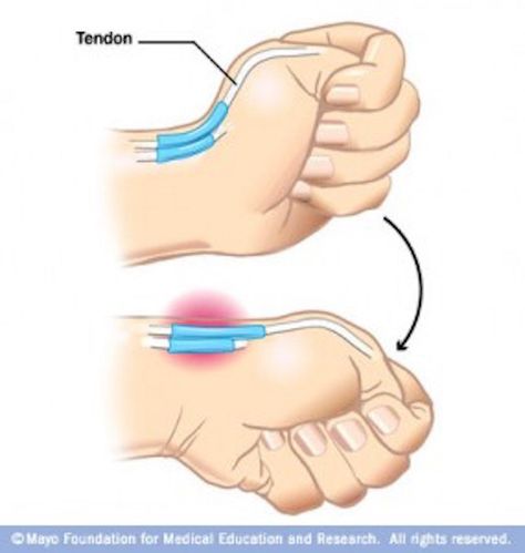 Dupuytren's Contracture, Wrist Pain, Hand Therapy, Carpal Tunnel, Mayo Clinic, Sports Medicine, Humor Memes, Physical Therapist, Anatomy And Physiology