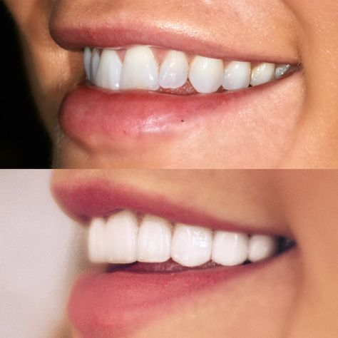 Veneers Before & After: The Prep, The Decision, The Results | Cella Jane Veneers Before And After Small Teeth, Hollywood Smile Veneers, Dental Veneers Before And After, Teeth Veneers Before And After, Porcelain Veneers Before And After, Composite Veneers Before And After, Veneers Teeth Styles, Veneers Before And After, Celebrities With Veneers