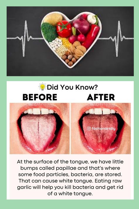 GET RID OF WHITE TONGUE #health #healthy diet #health tips #healthy foods #diet #diet tips #diet food #health benifits #remidies # white tongue # tongue # get rid of #garlic Healthy Tongue, Eating Raw Garlic, White Tongue, Tips Diet, Raw Garlic, Tongue Health, Diet Food, Health Healthy, Hair Health