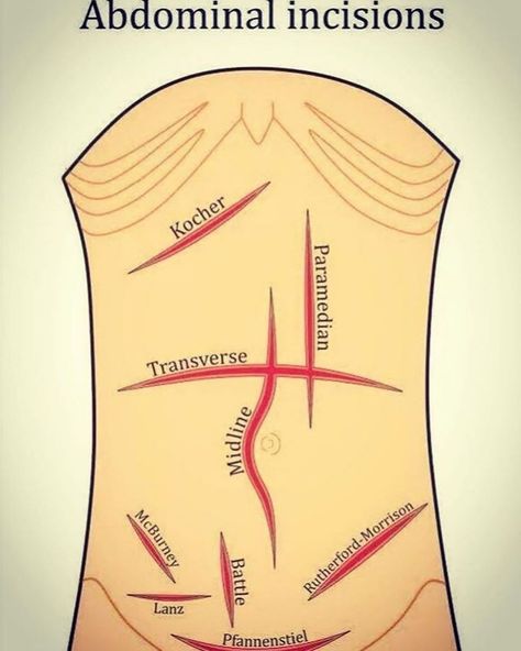 Medical_Mentor Medical Mentor on Instagram: “Different types of abdominal surgical incision #medical #surgery #surgeon #clinical #medicalstudent #doctor #healthcare” Abdominal Incisions, Nursing School Pharmacology, Surgical Technologist Student, Nursing School Studying Cheat Sheets, Anatomy Coloring, Medical Terminology Study, Perioperative Nursing, Medical Surgery, Surgical Technician