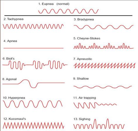 Biot's respiration and Cheyne Stokes Respiration. Respiratory Therapist Student, Respiratory Therapy Student, Breathing Patterns, Medical Terminology Study, Therapist Humor, Paramedic School, Nursing Assessment, Nurse Study Notes, Nursing Mnemonics