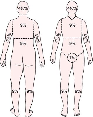 Rule of nines | definition of rule of nines by Medical dictionary Rule Of 9 Burns Nursing, Burns Nursing, Rule Of Nines, Paramedic School, Nursing Information, Burn Injury, Med Surg Nursing, Medical Dictionary, Nclex Study