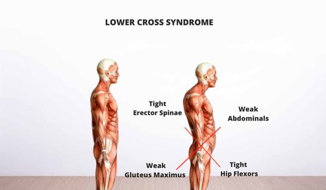 Lower Cross Syndrome, Upper Cross Syndrome, Bridge Workout, Fix Your Posture, Chronic Lower Back Pain, Gluteal Muscles, Piriformis Syndrome, Lower Back Muscles, Pelvic Tilt