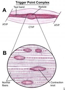 Punkty Spustowe, Neuromuscular Therapy, Tension Release, Psoas Release, Trigger Point Massage, Muscle Knots, Massage Therapy Techniques, Craniosacral Therapy, Dry Needling