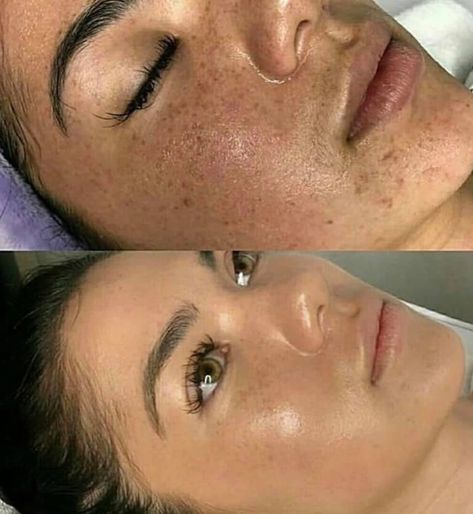 BB Glow - Your answer to a sunkissed look without having to damage your skin #bbglow #sunkissedskin #tannedskin #semipermenantfoundation #beyoutifultraining Facial Before And After, Poreless Skin, Botox Lips, Bb Glow, Sunkissed Skin, Botox Fillers, Uneven Skin Texture, Skin Care Spa, Chemical Peel