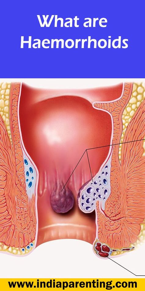 What are Haemorrhoids Hemorrhoid Exercise, Hemorrhoid Removal, Thrombosed Hemorrhoid, Hemorrhoid Remedies, Hemorrhoid Relief, Nose Picking, Sleep Remedies, Surgery Recovery, Health Planner