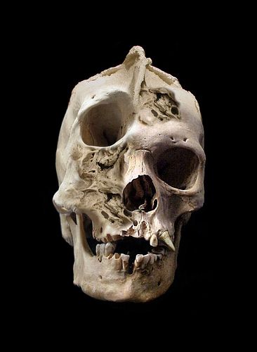 Adult human skull with severe craniofacial deformity. Skull Reference, Human Oddities, Human Skull, Skeletal, Human Anatomy, Skull And Bones, Skull Art, Dark Art, In The Dark