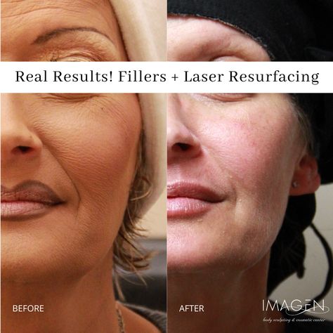 Fractional Laser, Laser Resurfacing, Facial Fillers, Facial Rejuvenation, Body Sculpting, Sun Damage, Skin Texture, Wrinkles, Your Skin