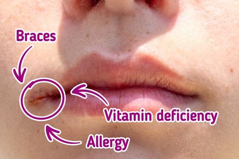 Perhaps many of us have faced a situation when painful cracks and inflammation appeared in the corners of our lips. It seems it happens without any reason — they just appear at some moment and then disappear after some time, having caused a bit of discomfort. 5-Minute Crafts collected information about this phenomenon and is going to tell you about the reasons for its appearance and the methods to prevent it. Cracks On The Side Of Mouth, Cracks In Corner Of Mouth, Cracked Lip Corners, Cracked Corners Of Mouth, Lips Cracked, Dry Cracked Lips, Cracked Lips, What To Use, Chapped Lips