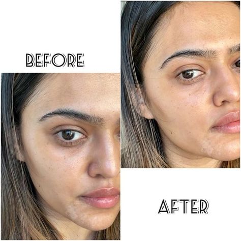 If you are a woman of color, especially if you are Indian, you know how under eye dark circles are kind of a problem for us Indian women. |dark circles| fade dark circles| Vitamin E | Almond oil| skincare routine| skincare regimen| Southasian skin| skincare| under eyes| antiaging| clean skincare| affordable skincare #skincareroutine #darkcircles #skincare #undereyes #antiaging Hyperpigmentation Around Eyes, Hyperpigmentation Indian Skin, Dark Circle Treatments, Indian Skincare Products, Hyperpigmentation Remedies, Dark Circle Remedies, Skin Korean, Affordable Skincare, Hide Dark Circles