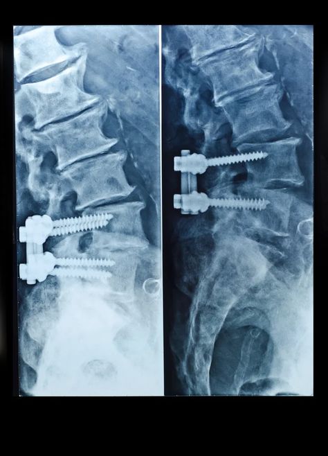 Symptoms of Loose Screws After Spinal Fusion | Premia Spine Spinal Fusion Surgery, Spinal Fusion, Spine Surgery, Spine Health, Surgery Recovery, Back Pain Relief, Surgery