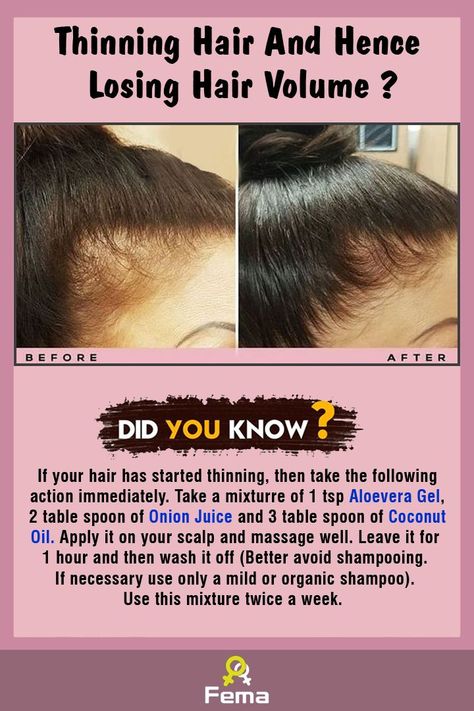 Silky Hair Remedies, Onion Juice For Hair, Thining Hair, Diy Hair Oil, Thinning Hair Remedies, Losing Hair, Hair Growth Challenge, Hair Today Gone Tomorrow, Hair Growth Foods