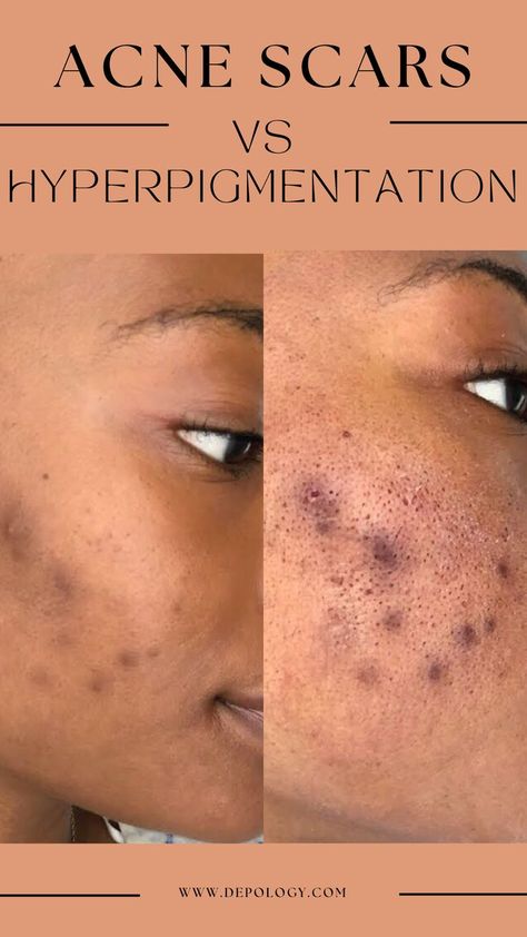 Acne and hyperpigmentation are two conditions that every person wants to avoid. The treatment also differs depending on one’s skin type. Skincare Terms, Pigmentation Remedy, Skin Care Hyperpigmentation, Blind Pimple, Pimples Under The Skin, Melanin Skin, Acne Overnight, Pimples Overnight, Natural Acne Remedies