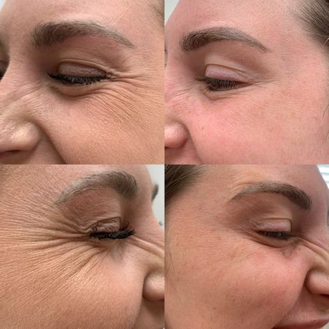 Em Sculpting Before And After, Face Injections, Pdo Thread Lift, Botox Results, Botox Facial, Prp Hair, Thread Lift, Wallpaper Ios, Beauty Boost