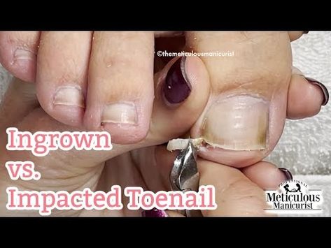 Curled Toenails, Ingrown Toenail Remedies, Fungal Infection Remedies, Toenail Health, Toenail Fungal Infection, Toenail Removal, Nail Remedies, Ingrown Toenail, Nail Infection