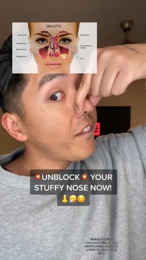 Stuff Nose Remedies, How To Unblock Nose, Popping Blackheads Youtube Videos, Sinus Inflammation, Back Workout Men, Sinus Health, Stuffy Nose Remedy, Health Humor, Sick Humor