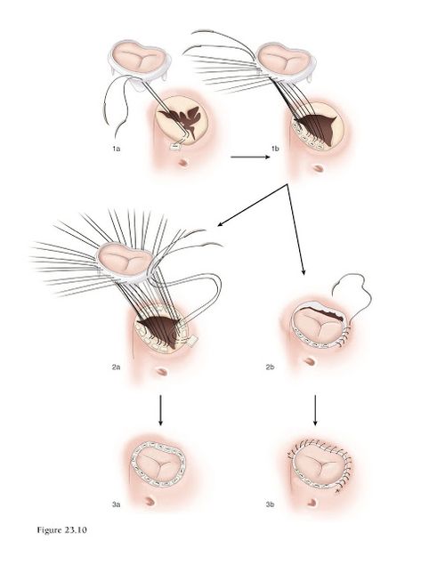 Tricuspid Valve, Mitral Valve, Heart Blocks, Congenital Heart, Coronary Arteries, Medical Anatomy, Cardiovascular System, Cardiology, My Heart Is Breaking