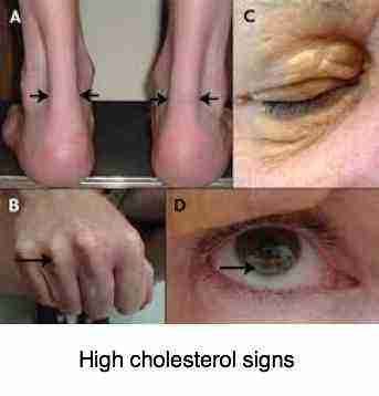 High Cholesterol Eye Symptoms High Cholesterol Symptoms, Foods To Reduce Cholesterol, Ways To Lower Cholesterol, What Causes High Cholesterol, Cholesterol Symptoms, Cholesterol Test, Cholesterol Foods, High Cholesterol Levels, Cholesterol Remedies