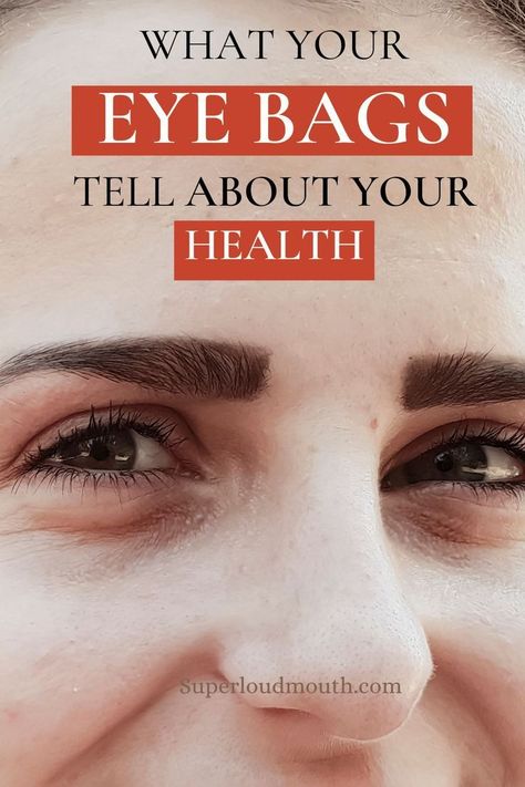 common nail problems Get Rid Of Eye Bags, Rid Of Eye Bags, Eye Bag Remedies, Eye Health Remedies, Eye Medicine, Puffy Eyes Remedy, Different Types Of Eyes, Nail Problems, Remove Dark Circles