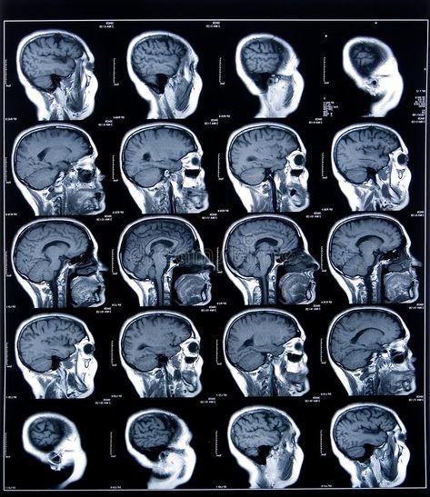 Photo about Health medical image of an mri of the head showing the brain. Image of medicine, human, brain - 4839785 Med Doctor, Science Homework, Brain Images, Medical Photos, Sleep Studies, Medical Imaging, Medical Anatomy, Graphic Design Fonts, Medical Aesthetic