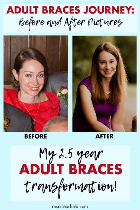 Braces Archives • Rose Clearfield Before And After Braces Pictures, Before And After Braces, Braces Journey, Braces Transformation, Braces Before And After, Braces Food, After Braces, Adult Braces, Zayn Malik Hairstyle