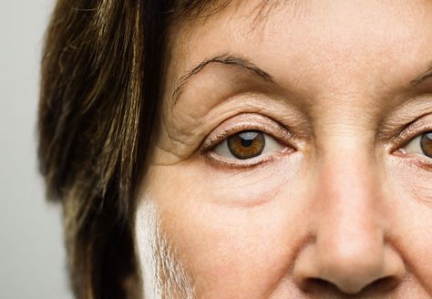 If you’re bothered by drooping eyelids and sagging, wrinkled skin around your eyes, injections or restorative surgical options could help make your eyes look more youthful. Botox Brow Lift, Drooping Eyelids, Hyaluronic Acid Fillers, Droopy Eyelids, Eye Makeup Application, Droopy Eyes, Eyelid Lift, Extra Skin, Injectables Fillers