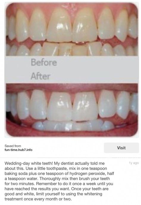 Instant White Teeth, Diy Vinegar, Natural Teeth Whitening Diy, Teeth Doctor, Nail Whitening, Tooth Filling, Get Whiter Teeth, Tooth Whitening, Teeth Whitening Diy