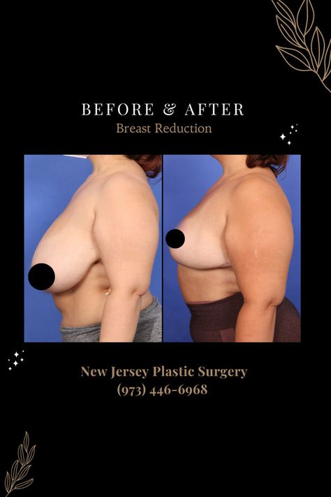 Breast reduction is sought for various reasons, primarily to alleviate physical discomfort caused by overly large breasts. This procedure can relieve chronic back, neck, and shoulder pain, improve posture, reduce skin irritation, and enhance mobility. 📞 Call 973-446-6968 For More Information Breast Reduction Surgery, Reduction Surgery, Neck And Shoulder Pain, Breast Reduction, Improve Posture, Shoulder Pain, Plastic Surgeon, Plastic Surgery, Irritated Skin