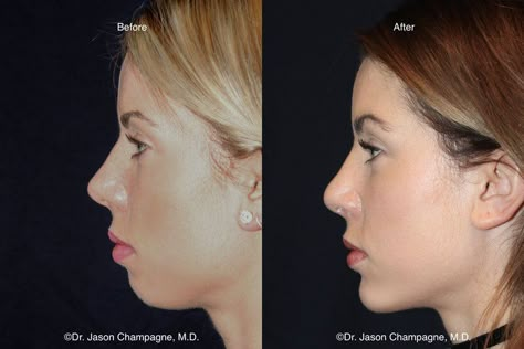 Chin Filler, Chin Augmentation, Chin Implant, Rhinoplasty Before And After, Face Surgery, Facial Bones, Jaw Surgery, Facial Surgery, Facial Fillers