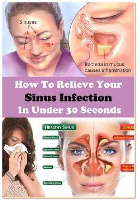 Home Remedy Sinus Infection, Relieve Sinus Headache, Sinus Blockage, Relieve Sinus Congestion, Remedy For Sinus Congestion, Blocked Sinuses, Clear Your Sinuses, Sinus Remedies, Relieve Sinus Pressure