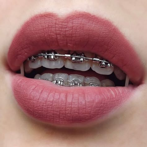 Perfect Teeth Braces, Cute Braces Colors, Teeth Aesthetic, Pretty Teeth, Braces Tips, Getting Braces, Braces Girls, Cute Braces, Windows To The Soul